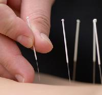 Cum ne ajută acupunctura?